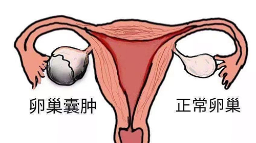 苏州哪里中医看卵巢囊肿好(图1)